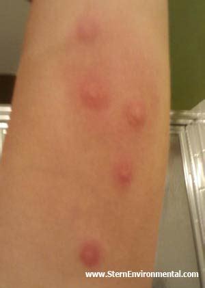 People that do have a reaction get small red pus filled bumps on the skin. {We are dentists. Forensic dentists}: Part 1 : Question 1