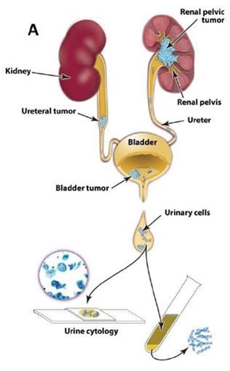 Gene Based Test For Urine Detects Monitors Bladder Cancer Drug Discovery And Development