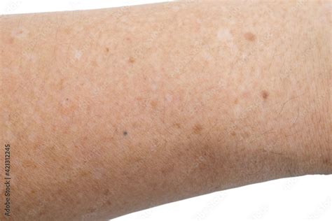 Small White And Brown Spots On The Skin Of Senior Man Arm Idiopathic
