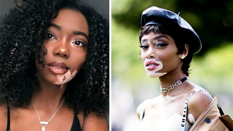Women With Vitiligo Are Finally Feeling Seen Glamour