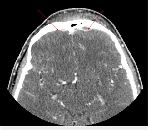 Ct Head With Contrast Shows Swelling And Enhancement Of The Front