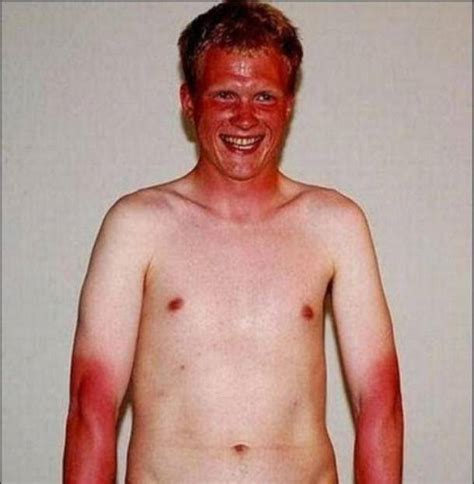Hilarious Examples Of Sun Tans Gone Very Wrong
