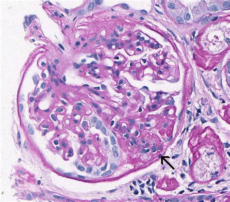 Focal Segmental Glomerulosclerosis Atlas Of Renal Lesions In