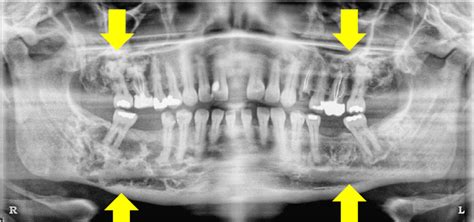 L Is For Location Lesion Dr Gs Toothpix