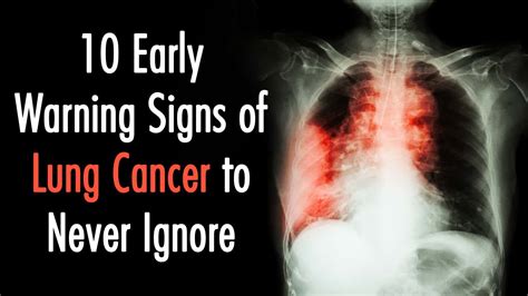 Early Signs Of Lung Cancer Non Lung Cancer Cell Mass Left Ray Chest Midzone Radiopaedia Version