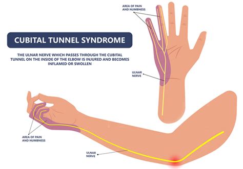 Cubital Tunnel Syndrome Shoulder Elbow