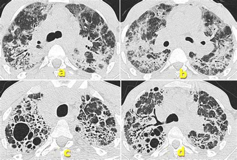 Ct Scan Lung Windowing A And B Bilateral Lung Consolidations And