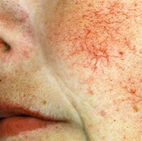 Telangiectasia Pictures Symptoms Causes Treatment Hubpages