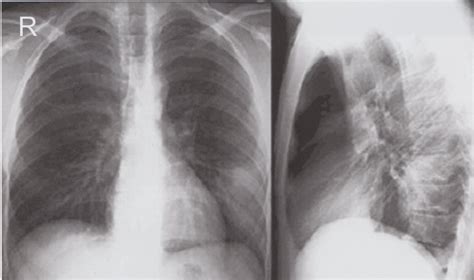 Chest X Ray Lobar Pneumonia