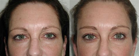 Forehead Lift Premier Plastic Surgery