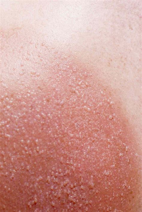 The Sun Poisoning Symptoms You Should Know—and How To Treat Them