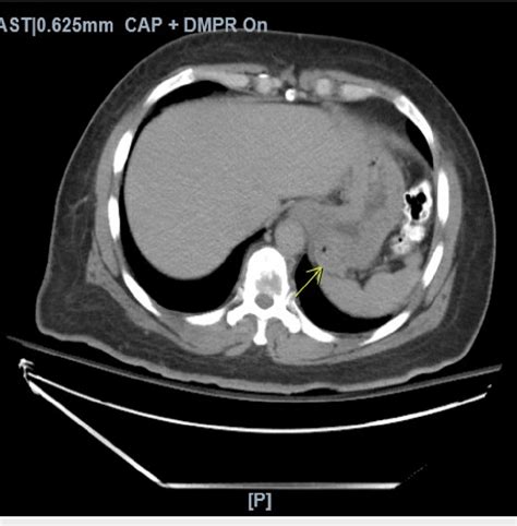 Figure 1 From A Rare Presentation Of Gastrointestinal Stromal Tumor