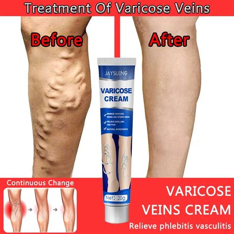 Effective Varicose Vein Relief Cream Ointment For Varicose Veins To