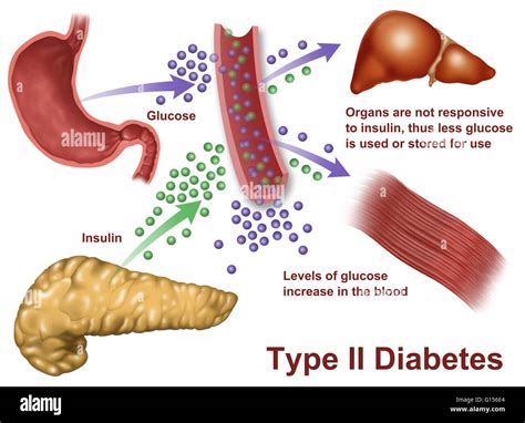 Llustration Of Insulin And Glucose Production In Type 2 Diabetes