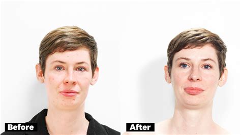 This Laser Treatment Got Rid Of My Rosacea Redness After Just One