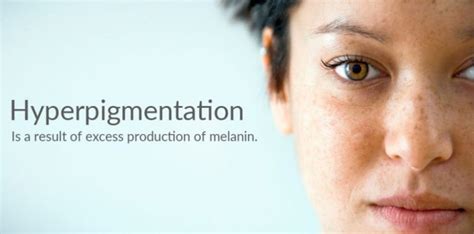How To Treat Hyperpigmentation Dermatologist Recommendations Justinboey