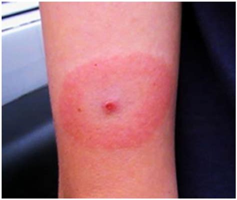 Erythema Migrans Em Like Lesion On Patient 3 Following Tick Exposure