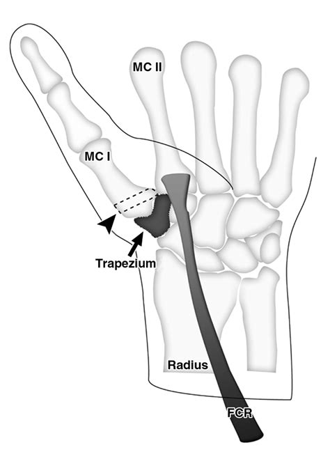 Radiologic Guide To Surgical Treatment Of First Carpometacarpal Joint Osteoarthritis AJR