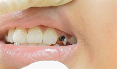 Black Teeth Causes And Treatment To Handle The Problem