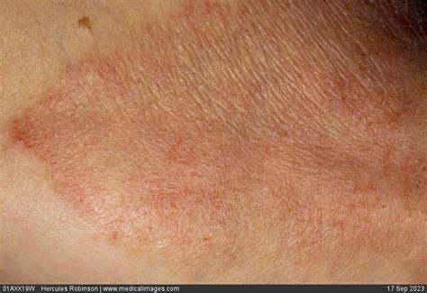 Stock Image Dermatology Psoriasis Extensive Dry Pink And Scaly Skin On