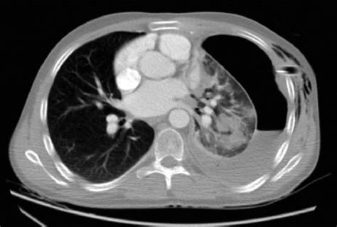 Chest Computed Tomography Scans Showed Pneumothorax Download