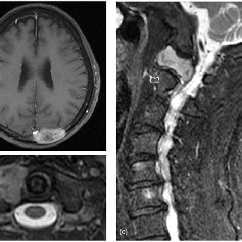 Preoperative Magnetic Resonance Imaging Mri Findings A T1 Weighted