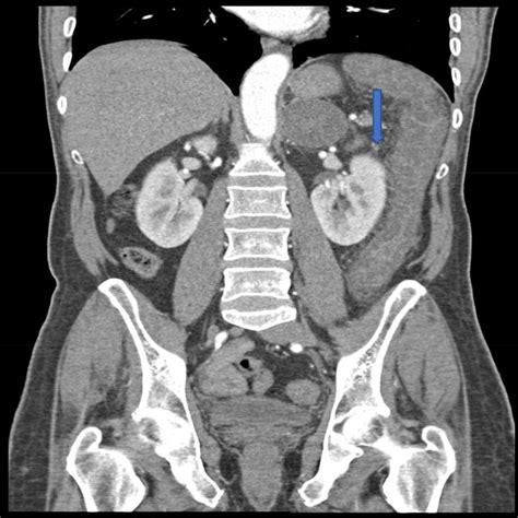 Diffuse Circumferential Wall Thickening Of The Large Colon Involving Download Scientific