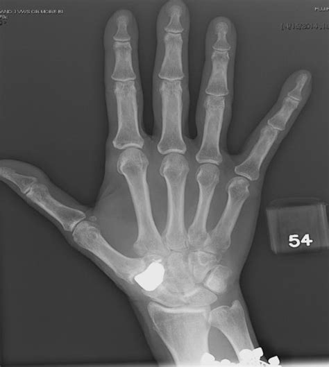 Failed Thumb Carpometacarpal Arthroplasty Common Etiologies And