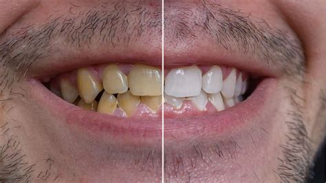 8 september 2017 | men. 10 Ways to Clean Yellow Teeth Naturally