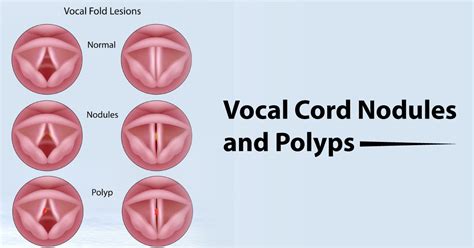 Vocal Cord Cysts And Polyps Vikram ENT Hospital Research Institute