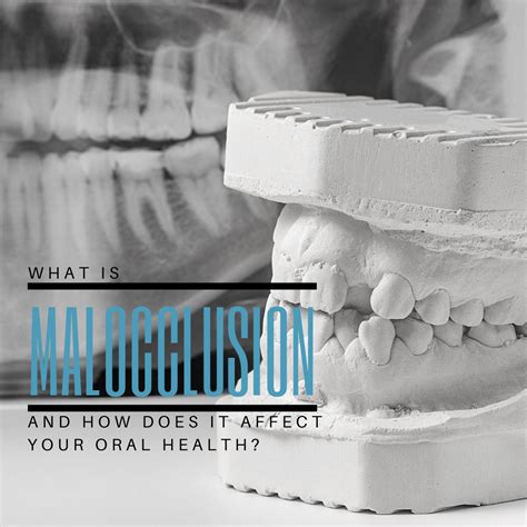 What Is Malocclusion And How Does It Affect Your Oral Health McLean