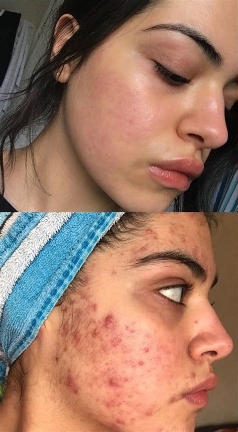 Acne Before And After Transformations Skin Care Acne Anti Aging Skin