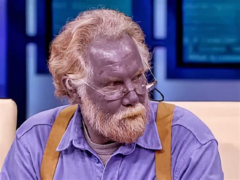 What Is Blue Man Syndrome Costamedic