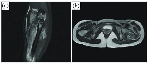 Mri Of Simple Bone Cyst Formation In The Intertrochanter Region Of The