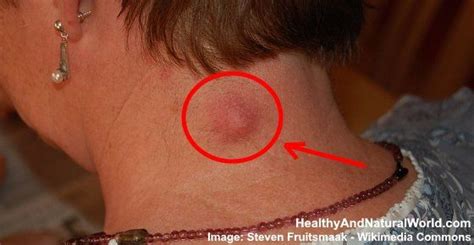 Use This To Quickly Get Rid Of Sebaceous Cysts Natural Acne Remedies