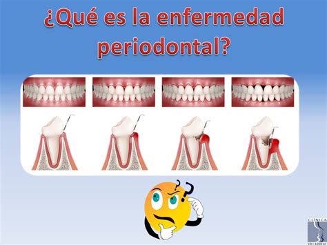 ¿qué Es La Enfermedad Periodontal Clinica Villarreal Maxilofacial