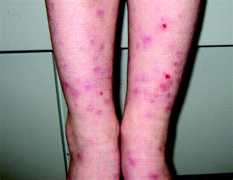 Recurrent Papular Urticaria In A 6 Year Old Girl Archives Of Disease