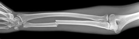 Broken Arm X Ray Photograph By Du Cane Medical Imaging Ltd Pixels