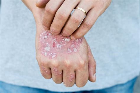 Man Scratch Oneself Dry Flaky Skin On Hand With Psoriasis Vulgaris