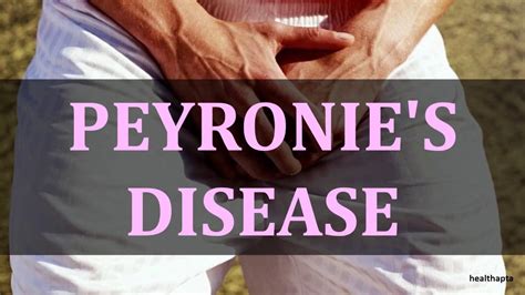 Peyronies Disease Youtube