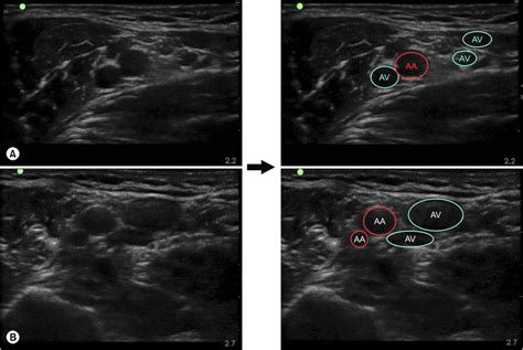 Brachial Axillary Vein