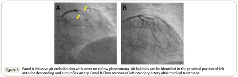 Simultaneous Massive Coronary Air Embolism And Intraprocedural S