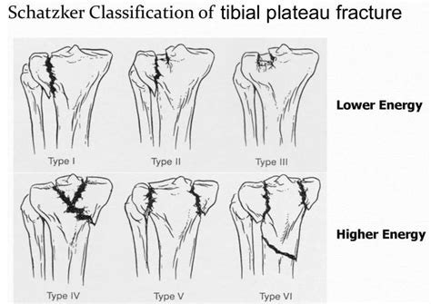 Tibial Plateau Fracture Causes Types Symptoms Diagnosis Treatment