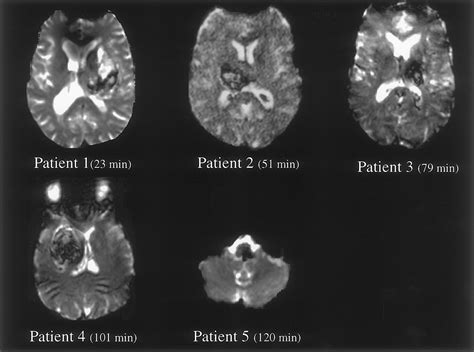 Mri Features Of Intracerebral Hemorrhage Within 2 Hours From Symptom