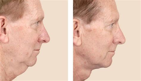 Neck Lift Platysmaplasty Surgery Recovery And What To Expect