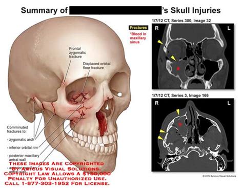 AMICUS Illustration Of Amicus Injury Summary Skull Blood Maxillary