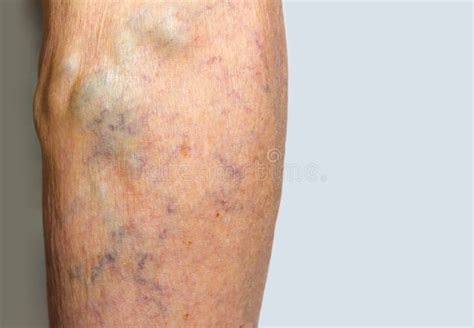 Varicose Veins On A Leg Stock Photo Image Of Care Body 85196800