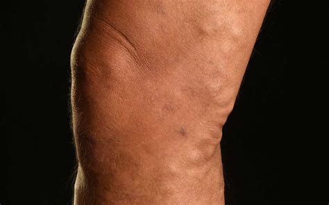 Causes Of Varicose Veins And Leg Ulcers
