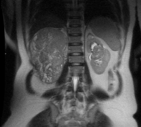 Multimodality Treatment Of Bilateral Wilms Tumor In A Pregnant Female
