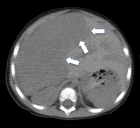 Ct Scan Of The Abdomen Without Contrast At The Diagnosis Of